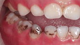 A close-up image of a child's teeth with black stains, representing the topic of understanding and treating black stains on children's teeth